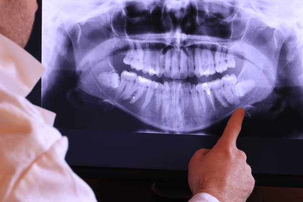 Best Emergency Dentist for Knocked-Out Tooth in Centerville, SC